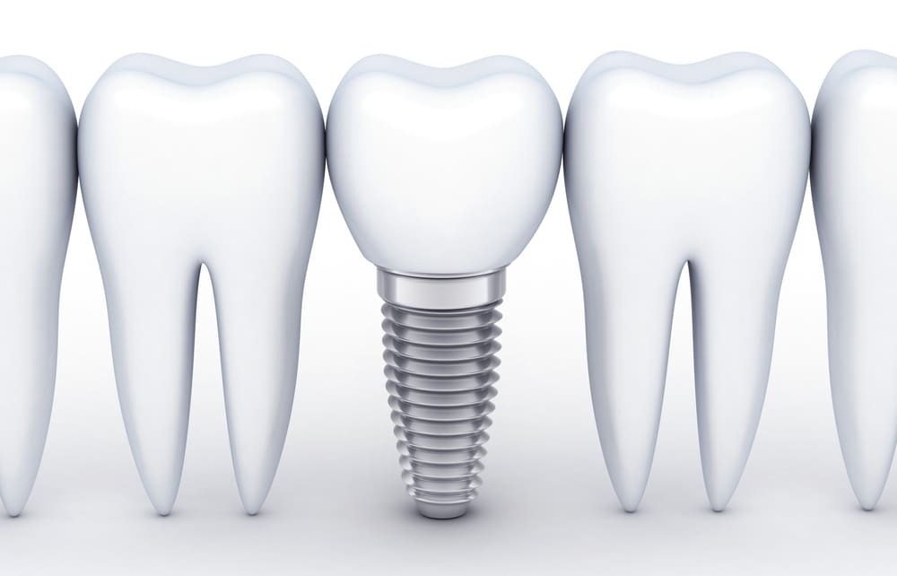 世界シェアNo.1のストローマンインプラントを使用
