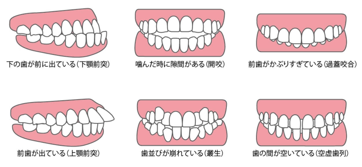 不正咬合の種類