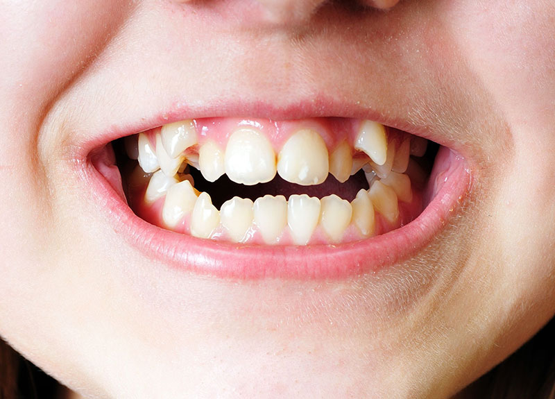 ホワイトニング