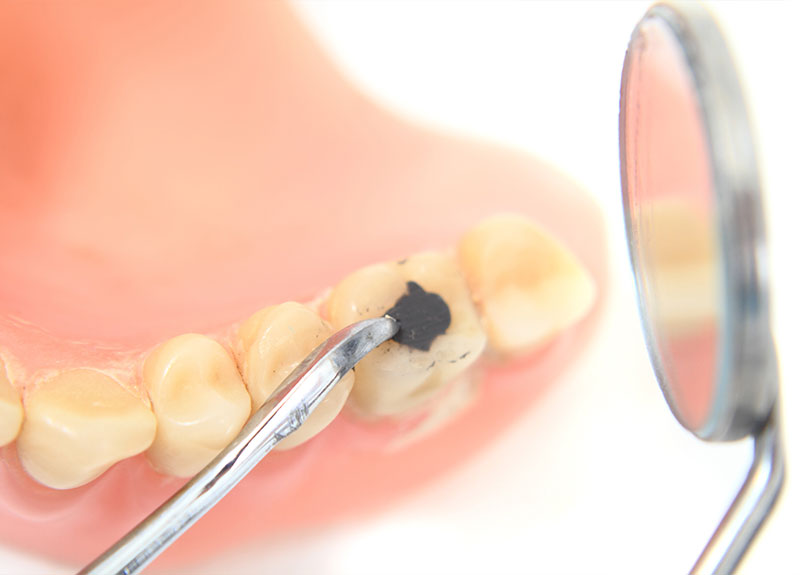 ホワイトニング