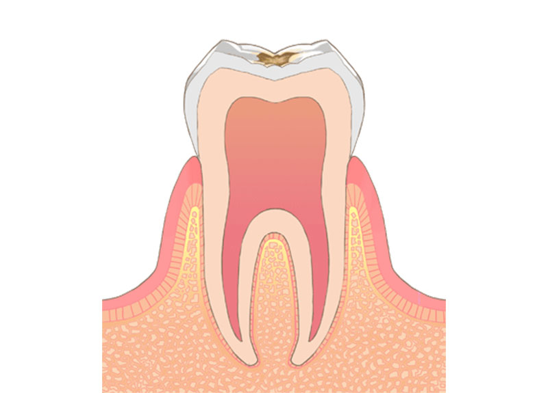 ホワイトニング