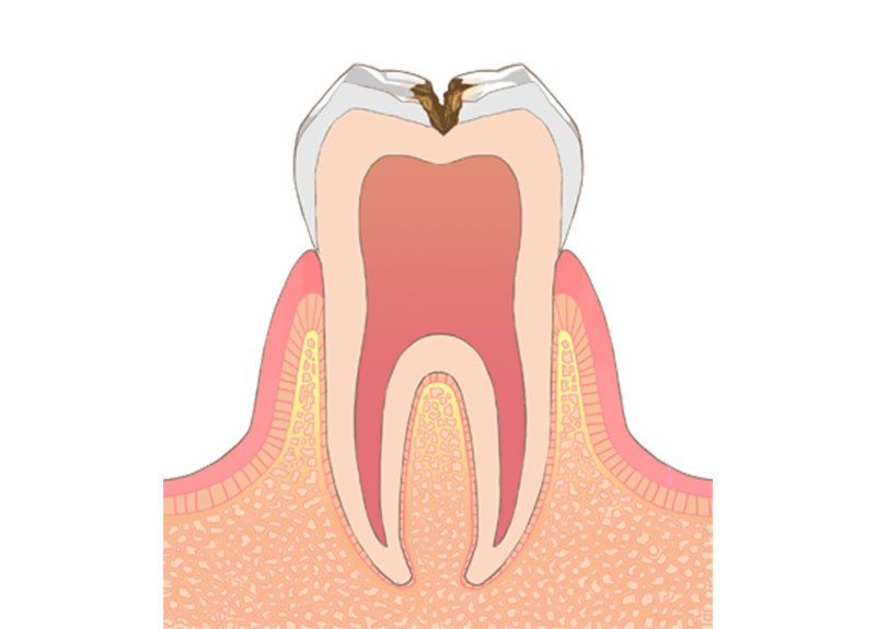ホワイトニング