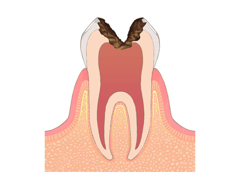 ホワイトニング