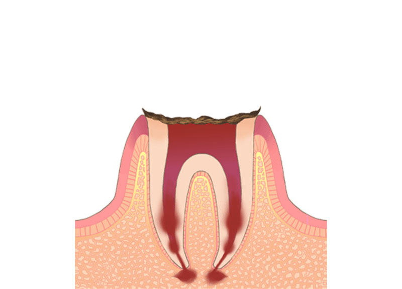 ホワイトニング
