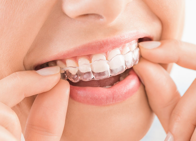 ホワイトニング