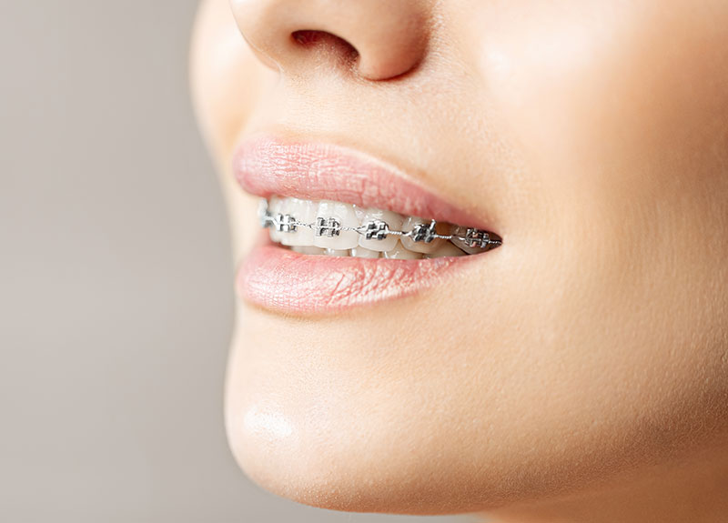 ホワイトニング