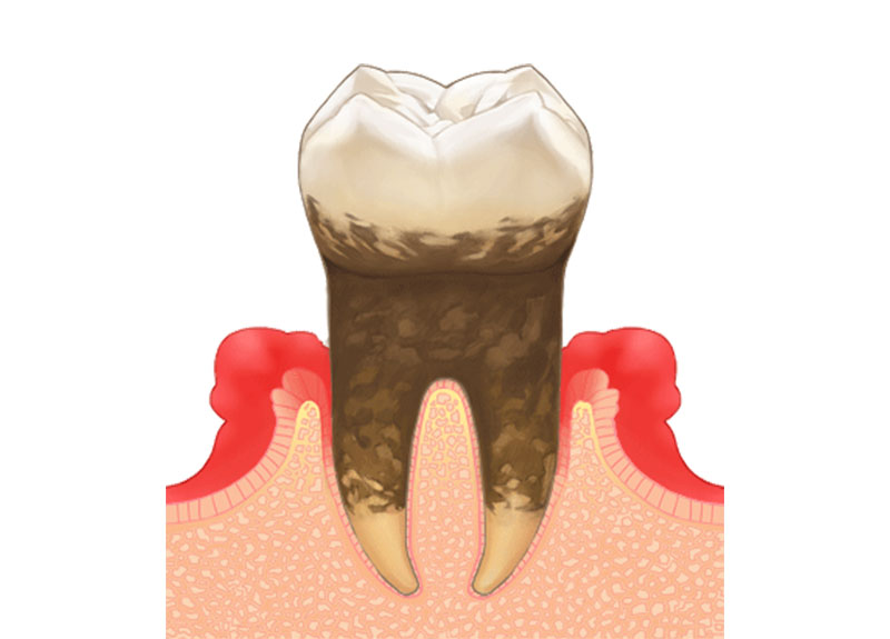ホワイトニング
