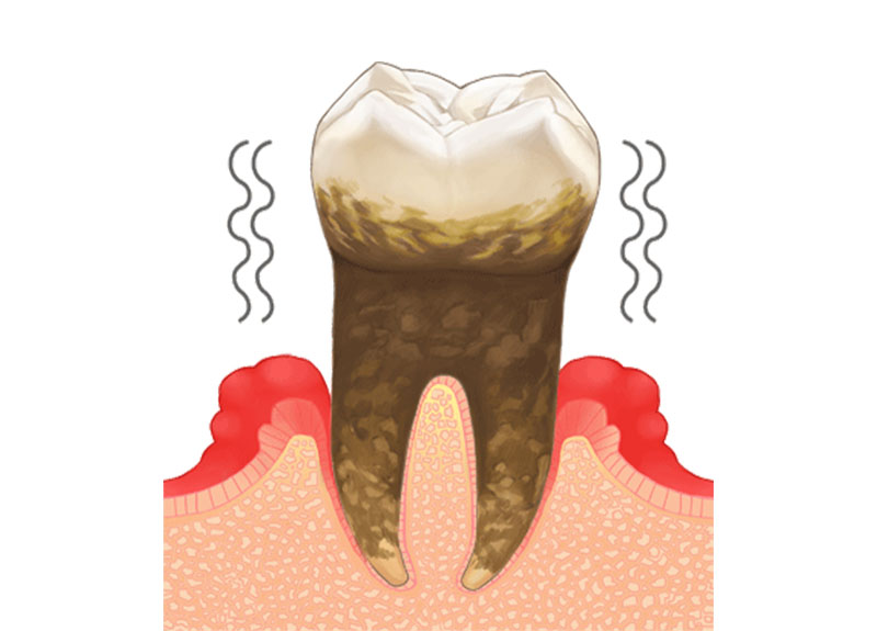 ホワイトニング