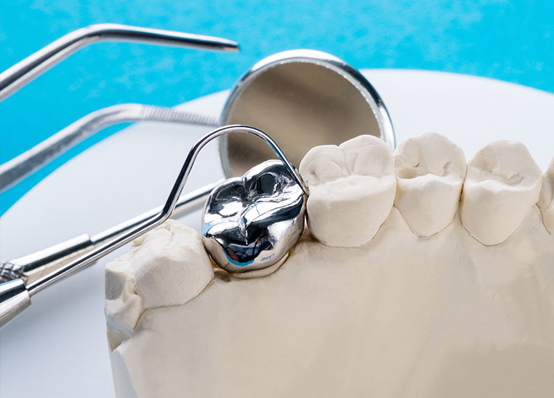 ホワイトニング