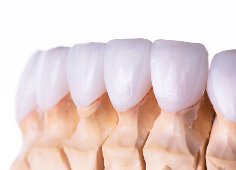 ホワイトニング