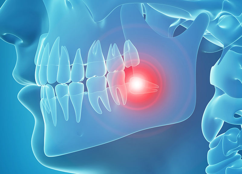 ホワイトニング