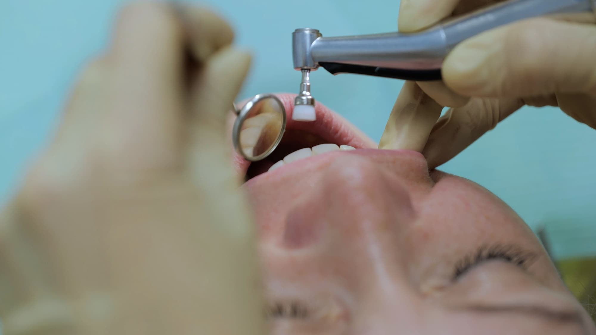 歯の表面を研磨する様子