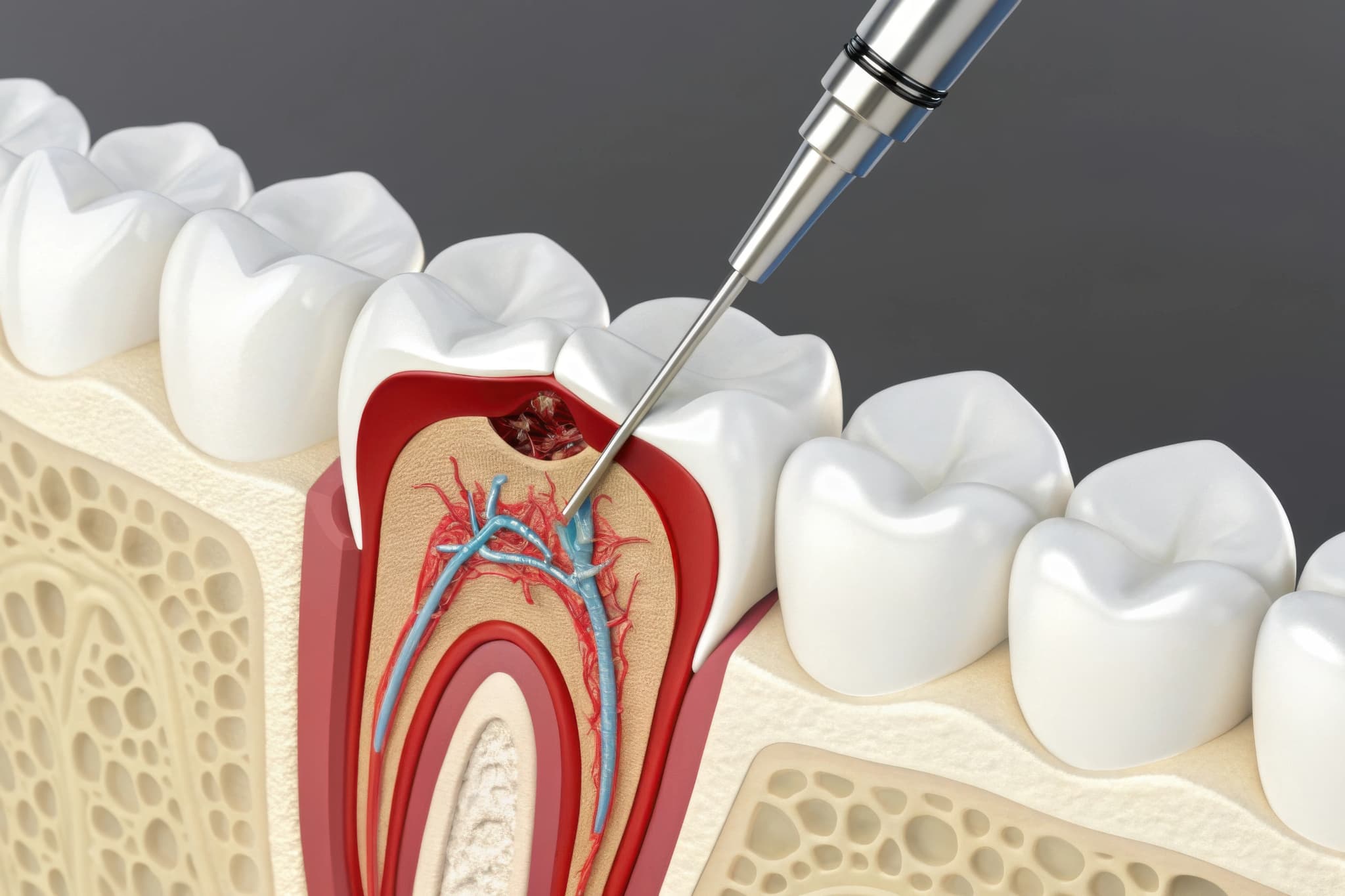 根管治療の様子