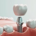 インプラントのイメージ