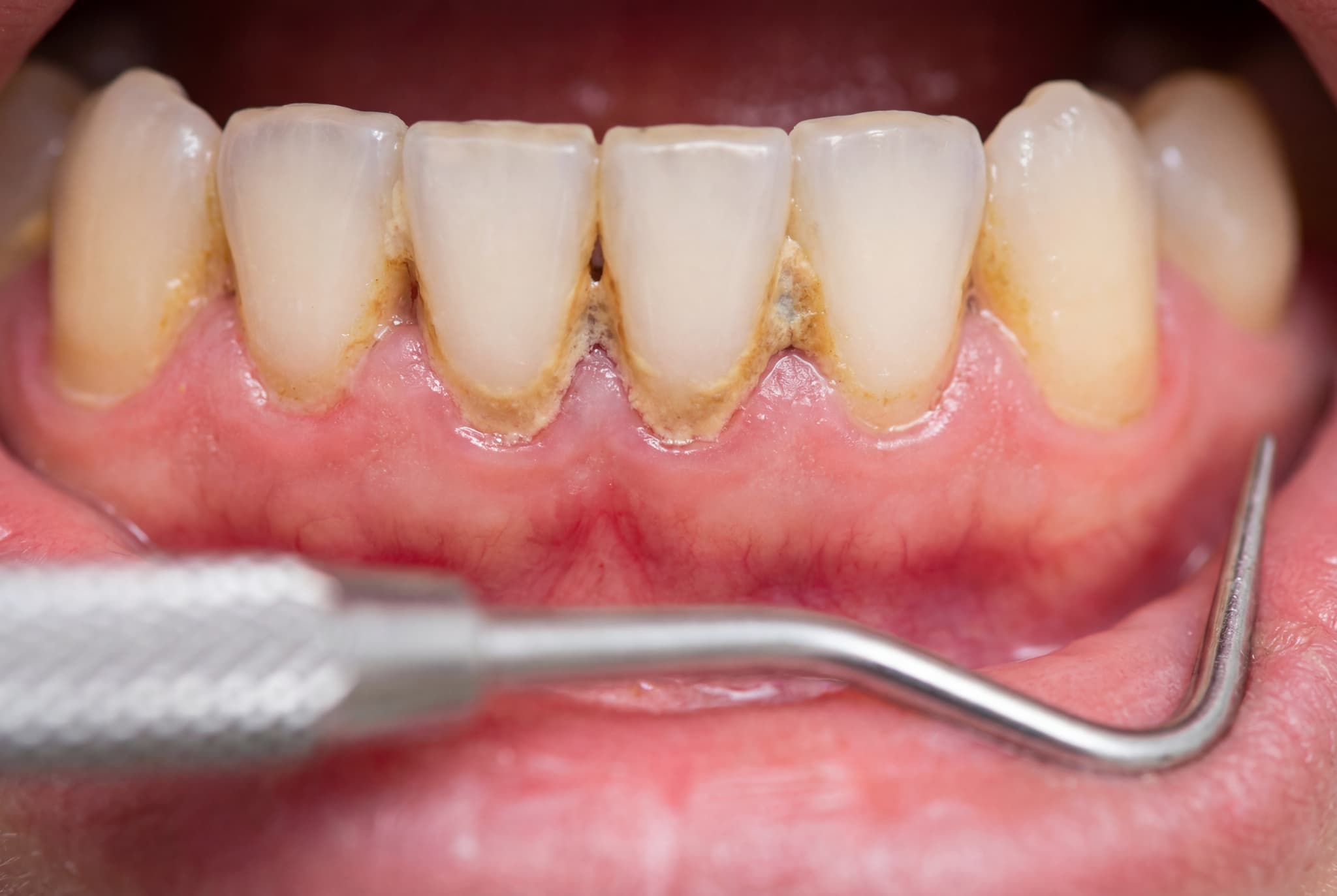 歯石の付いた口腔内