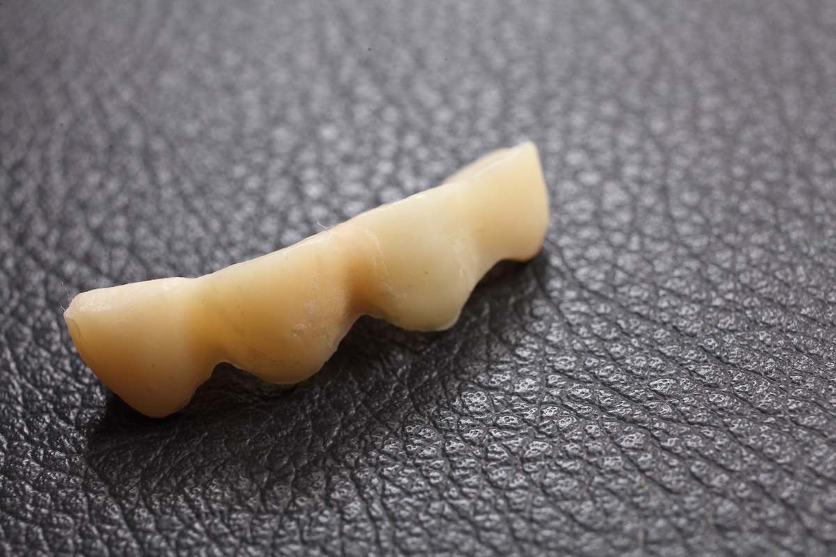 前歯を補う入れ歯